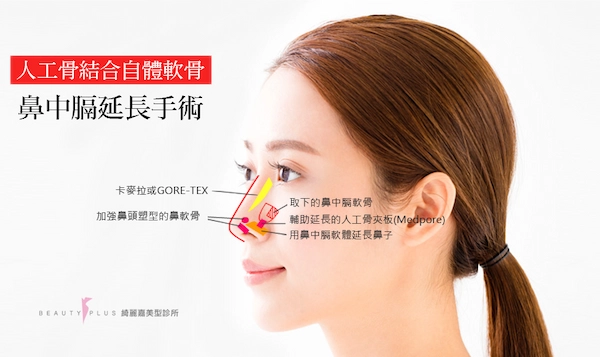 結構性隆鼻 結構性隆鼻