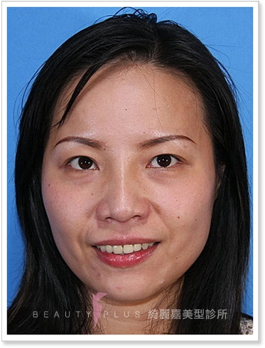 鼻中膈延長