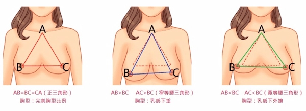 矽膠隆乳 矽膠隆乳