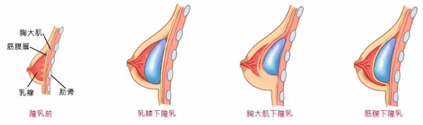 矽膠隆乳 矽膠隆乳