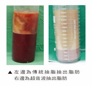 脂肪雕塑 脂肪雕塑
