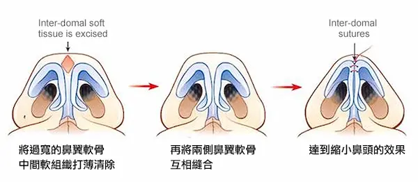 縮鼻翼手術示意圖