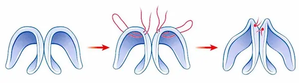 縮鼻翼手術示意圖3