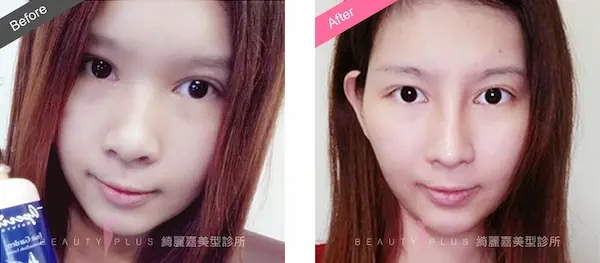 縮鼻翼手術案例