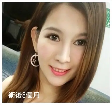 縮鼻翼手術術後8個月追蹤