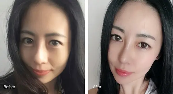 縮鼻翼手術案例