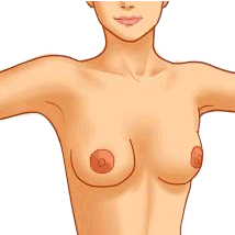 矽膠隆乳