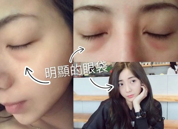 淚溝手術案例 淚溝手術案例