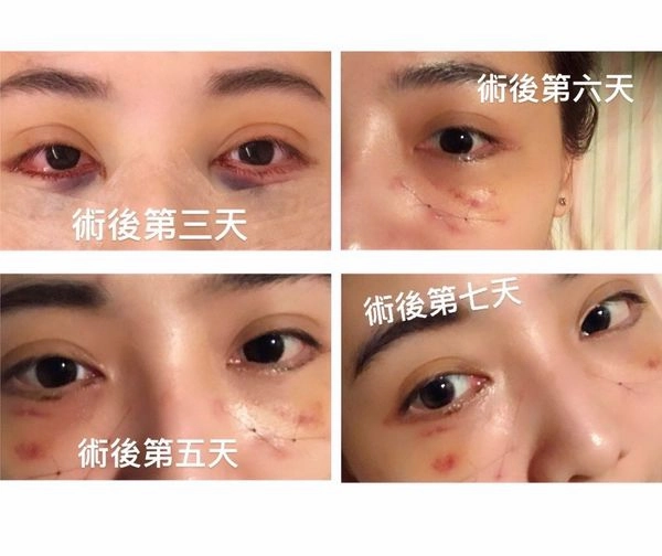 淚溝手術案例 淚溝手術案例