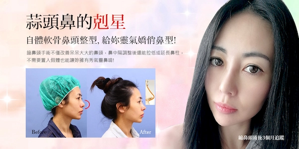 鼻頭整形案例 鼻頭整形案例
