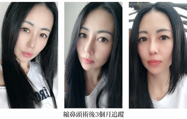 鼻頭整形案例 鼻頭整形案例