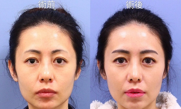 鼻頭整形案例 鼻頭整形案例