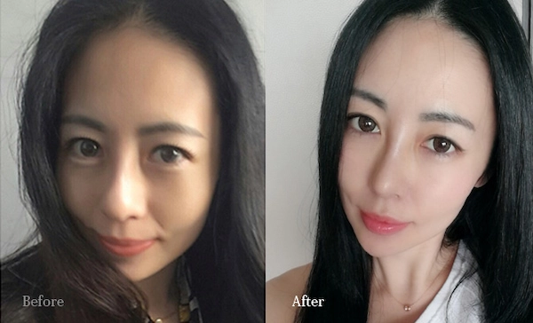 鼻頭整形案例 鼻頭整形案例