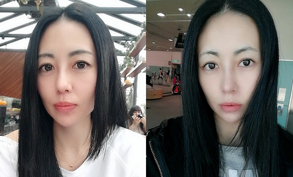 鼻頭整形案例 鼻頭整形案例