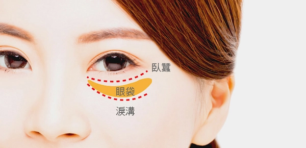 眼袋案例手術 眼袋案例手術