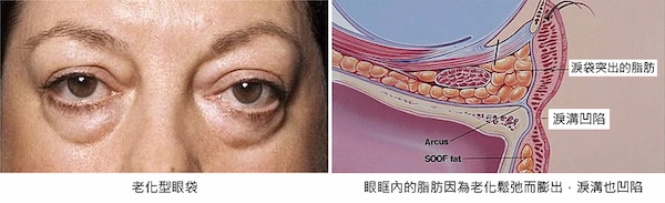 眼袋案例手術 眼袋案例手術