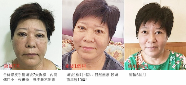 眼袋案例手術 眼袋案例手術