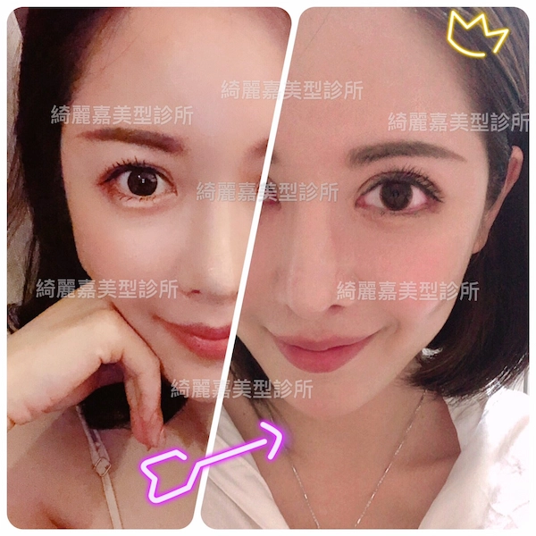 重修手術案例 重修手術案例