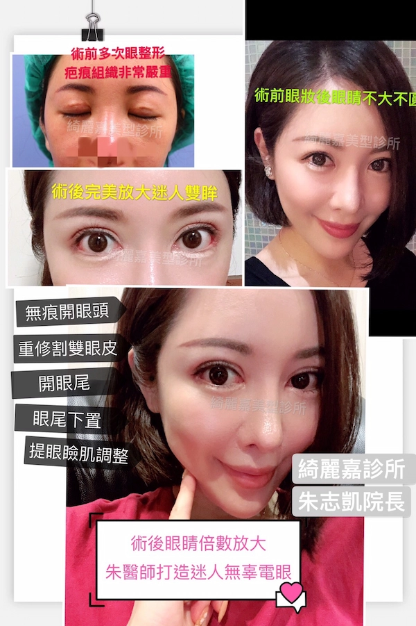 重修手術案例 重修手術案例