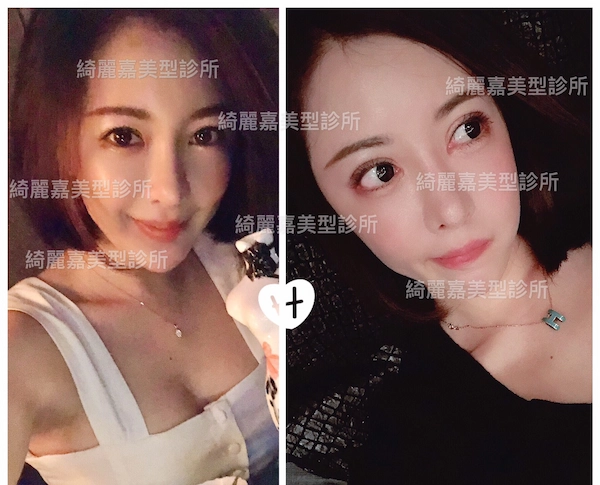 重修手術案例 重修手術案例