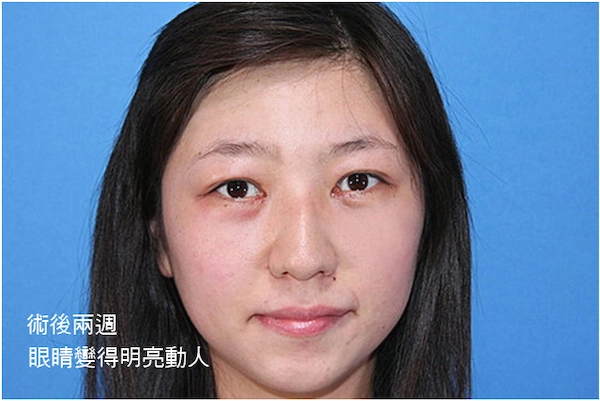 術後兩週