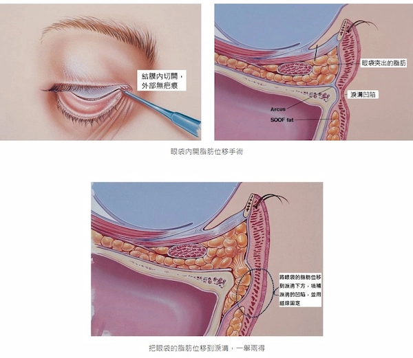 隆鼻眼袋案例 隆鼻眼袋案例