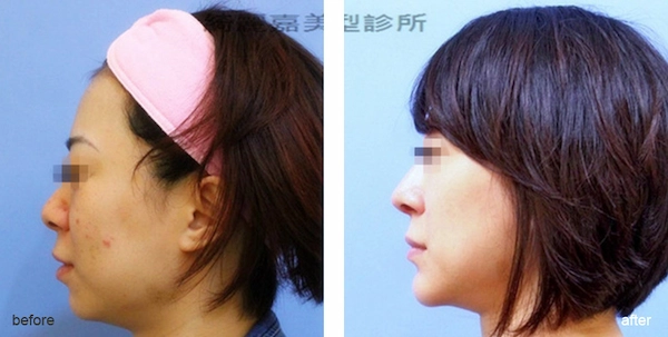 隆鼻眼袋案例 隆鼻眼袋案例