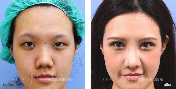 臉部整形案例 臉部整形案例