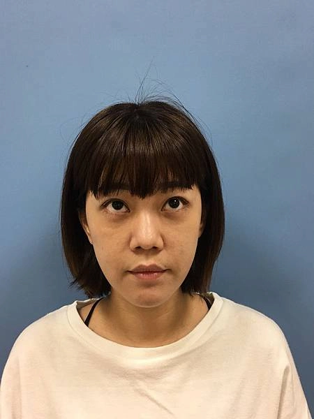眼袋手術