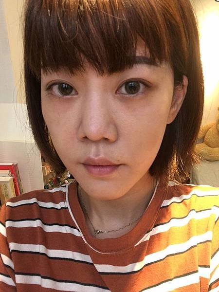 眼袋手術