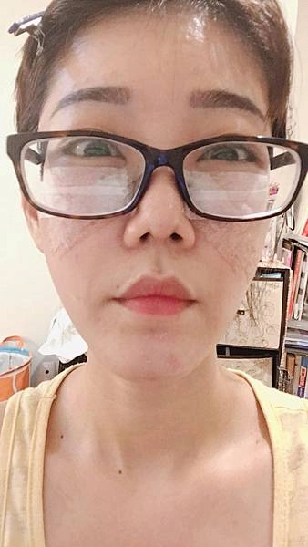 眼袋手術