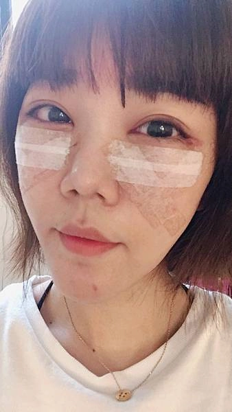 眼袋手術