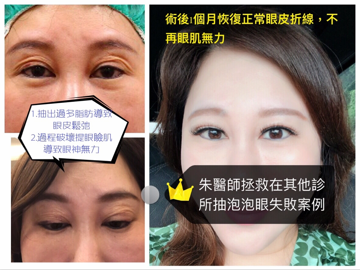 雙眼皮重修 雙眼皮重修