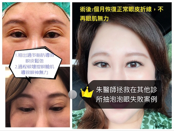 雙眼皮重修 雙眼皮重修