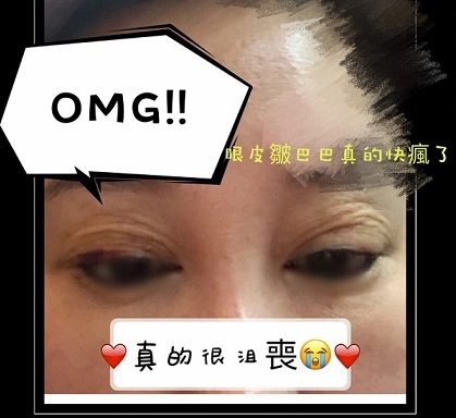 雙眼皮重修 雙眼皮重修