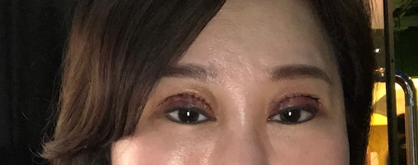 雙眼皮重修 雙眼皮重修 推薦開眼頭,眼尾,眼袋手術,微笑唇,改善淚溝,提眼肌無力|綺麗嘉