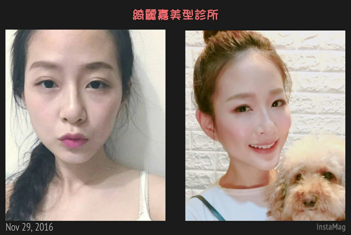 眼袋案例 眼袋案例