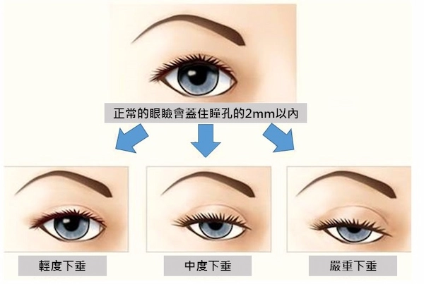 提眼肌無力說明