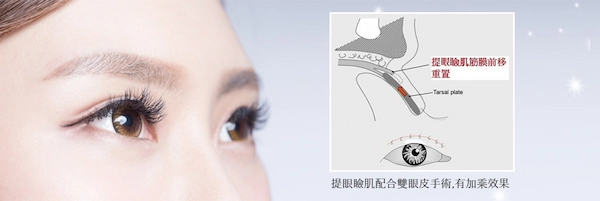 提眼肌無力搭配雙眼皮手術