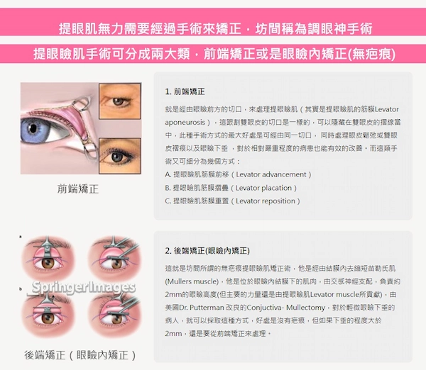 提眼肌無力手術分類