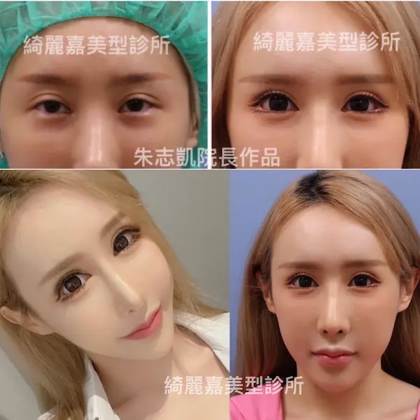 開眼尾及下置