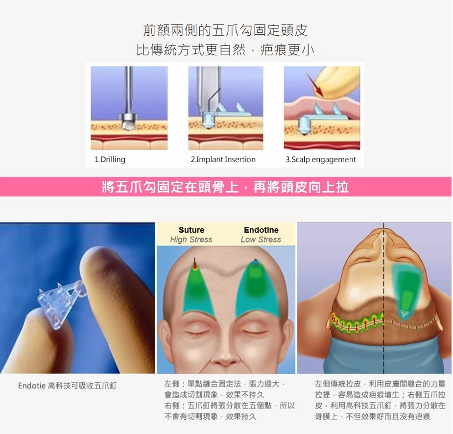台北提眉手術8