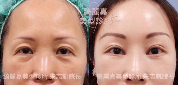 台北提眉手術案例