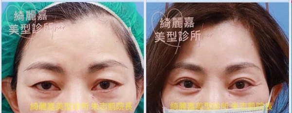 台北提眉手術案例5