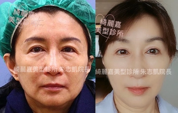 台北提眉手術案例6